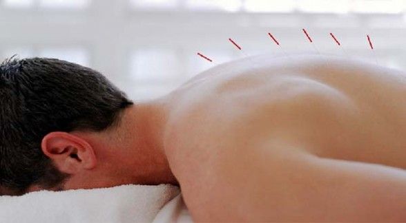 Acupuntura - Atendimento em domicílio